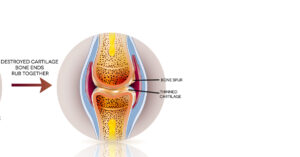 Image of destroyed knee cartilage and bone spur