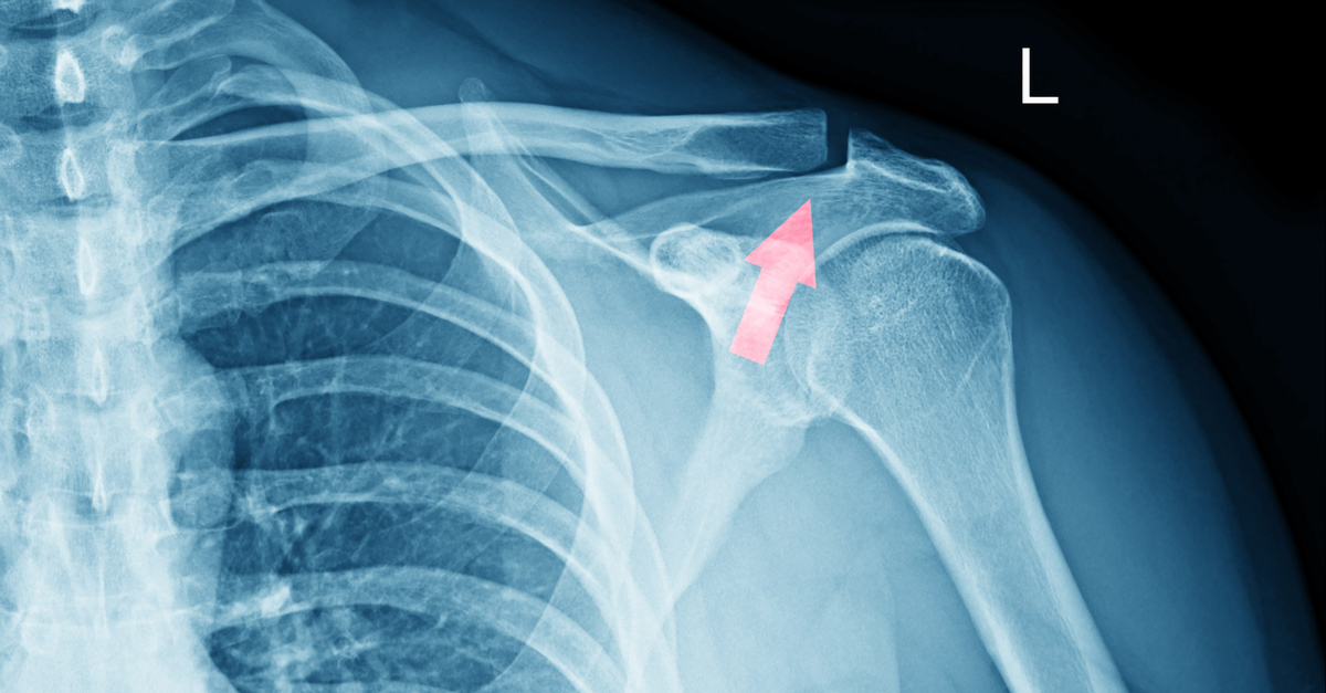 X-ray of a broken collar bone
