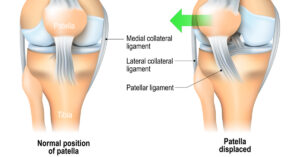 Image of the Patellar ligament