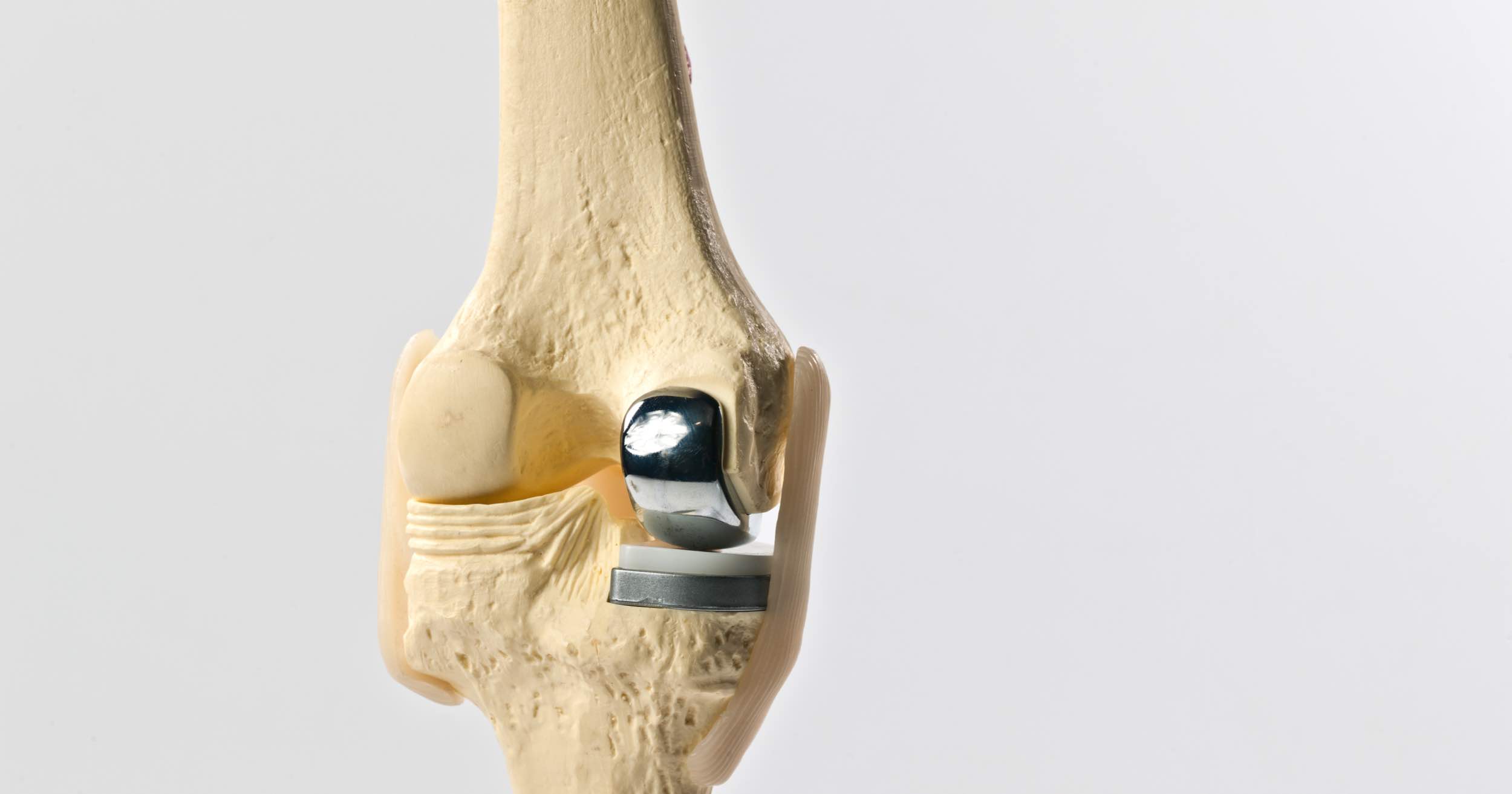 image of a partial knee replacement surgery