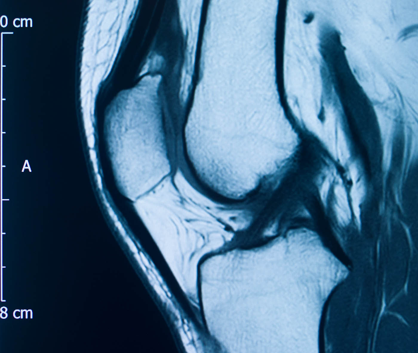 MRI image of a sports injury to someone's knee