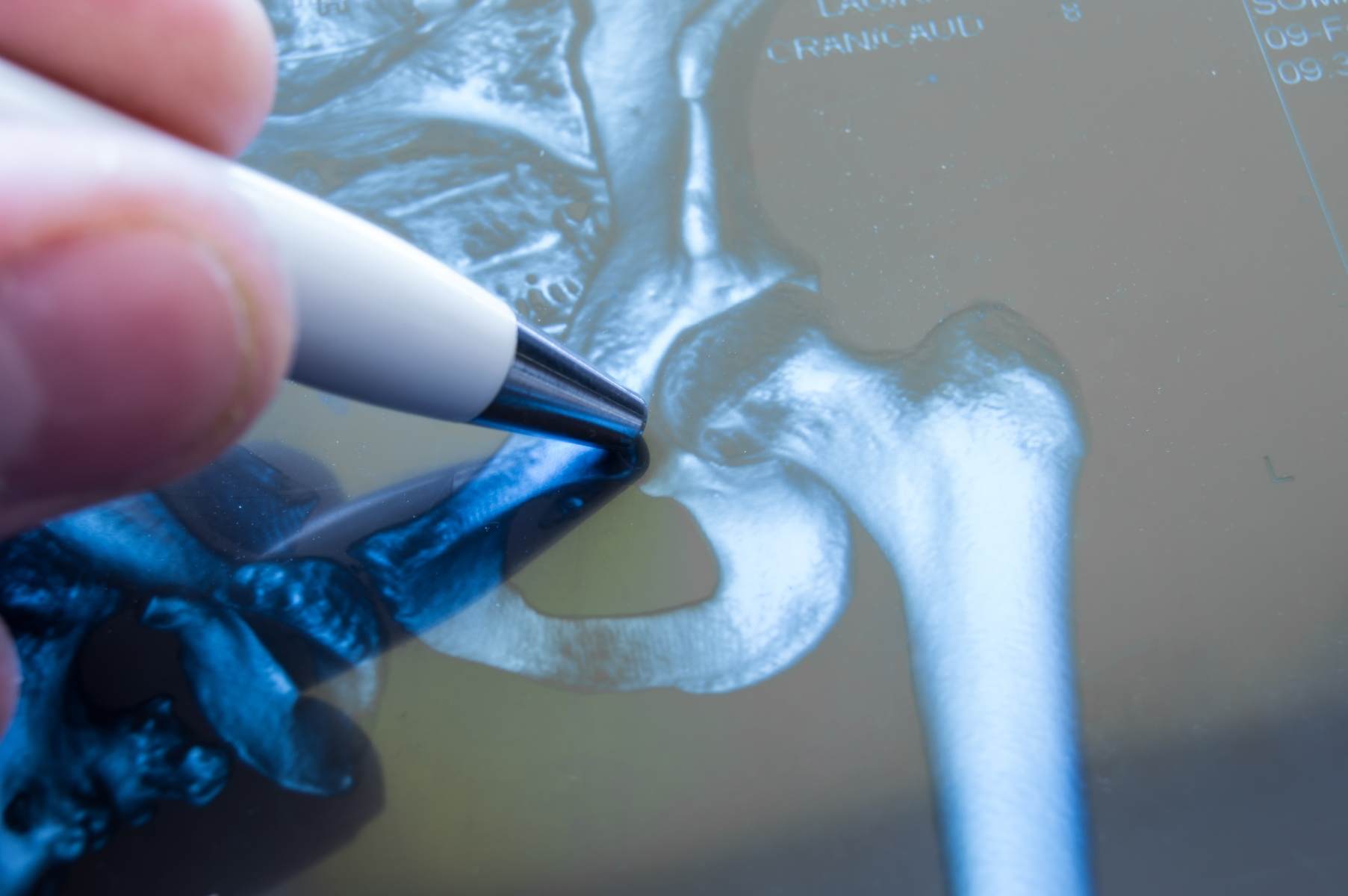 Indications for Total Hip Replacement in a Person with Osteoarthritis