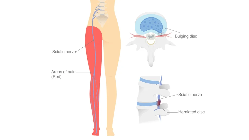 Can an EMG Help Find the Exact Level of My Herniated Disc Pain? - Total ...